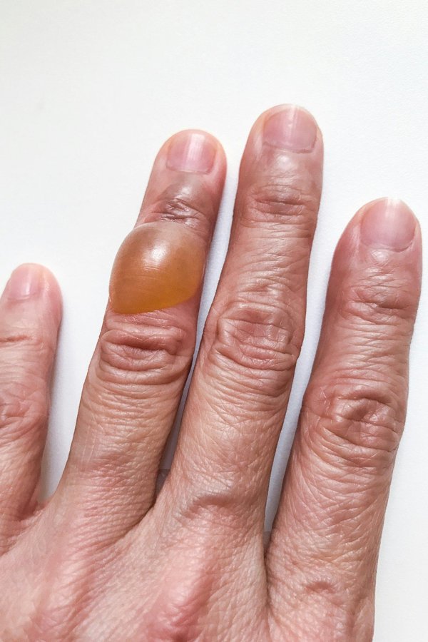 Biafine brûlure médicament : soulagement rapide et efficace